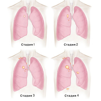 Стадии развития рака лёгкого