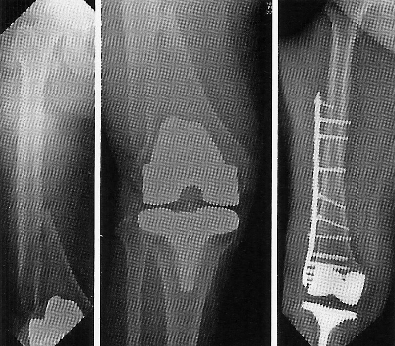 Рентген — снимок до и после операции