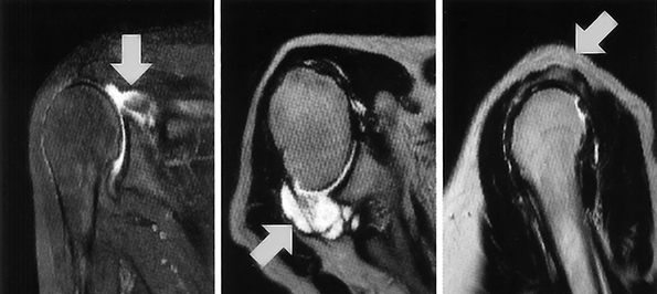 Снимок МРТ плечевого сустава до операции