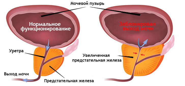 Гиперплазия предстательной железы