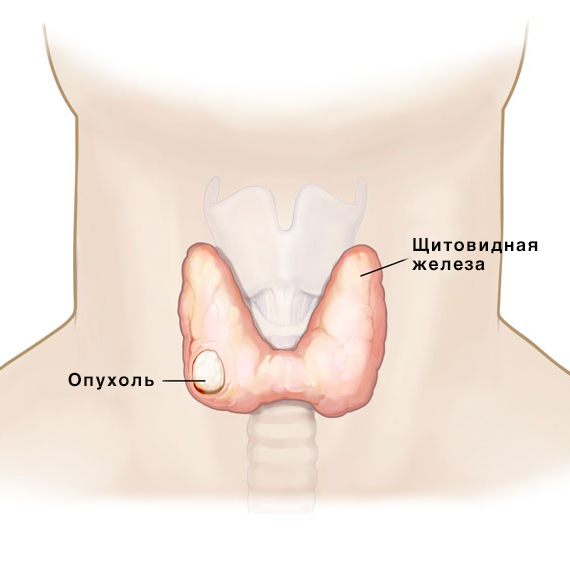 Рак щитовидной железы
