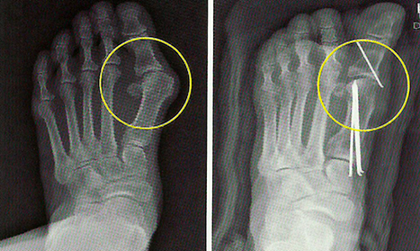 Деформация больших пальцев ног