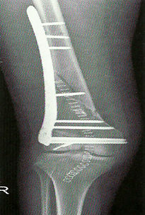 Перелом тела бедренной кости (диафизальный перелом)