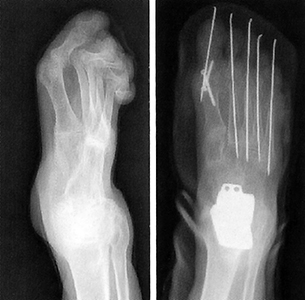 Деформация пальцев ног вызванная ревматоидным артритом