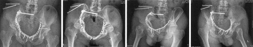 Рентген — снимок после операции